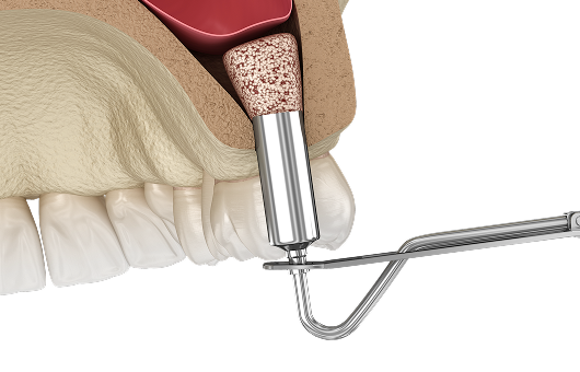 고난도 임플란트
