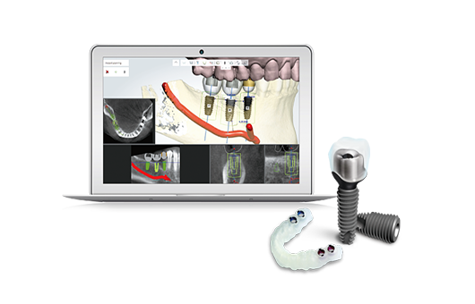 네비게이션(최소절개) 임플란트
