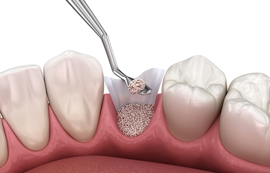 뼈이식 임플란트