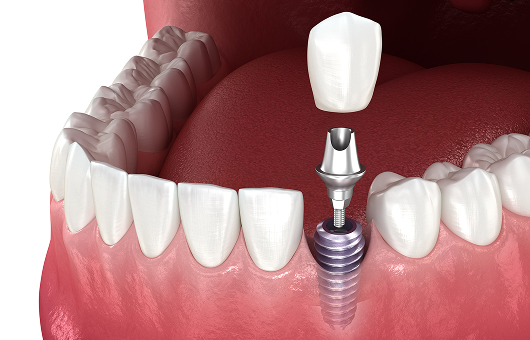 임플란트 재수술