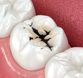 충치, 신경치료