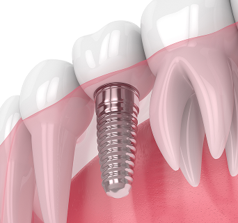 의식하진정 임플란트