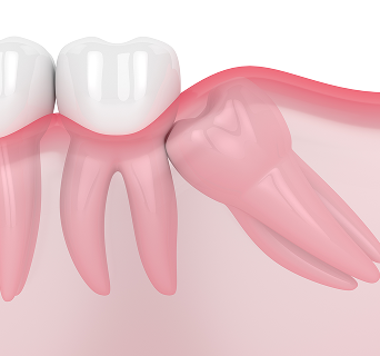 의식하진정 사랑니 발치