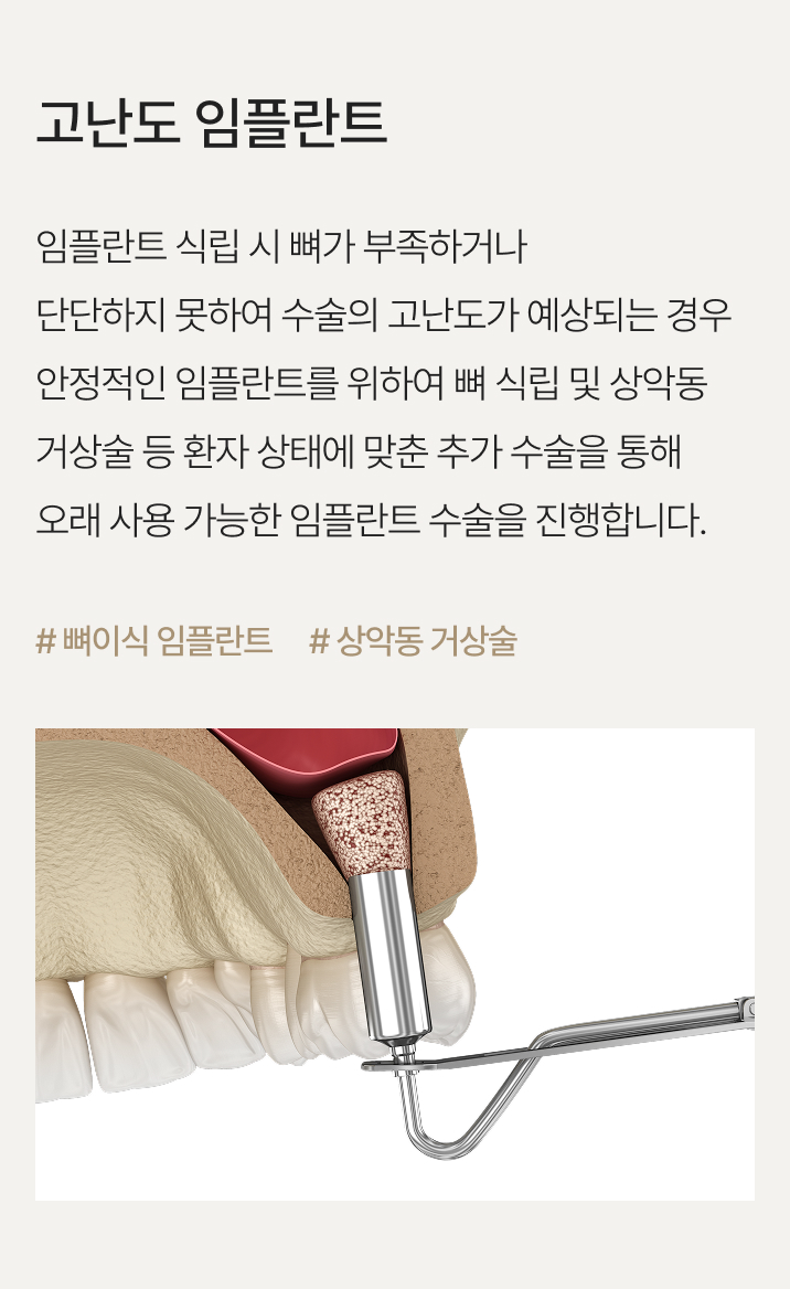 고난도 임플란트