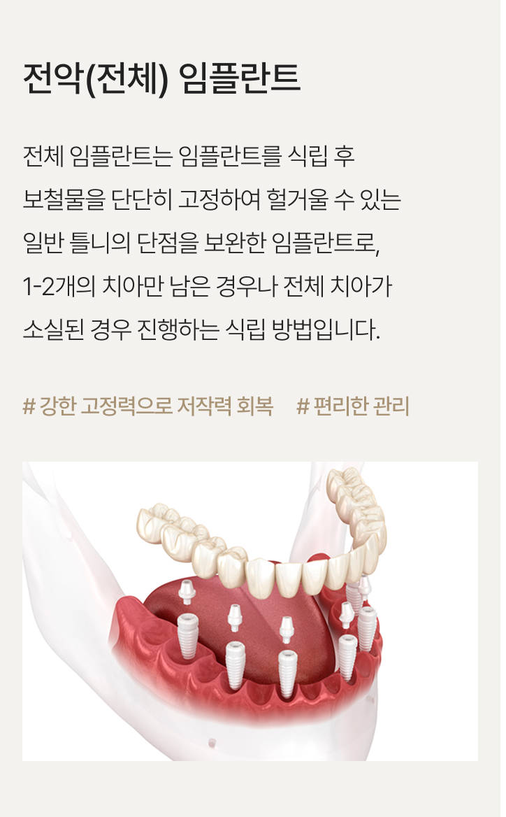 전악(전체) 임플란트