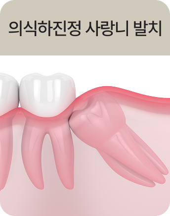 의식하진정 사랑니 발치